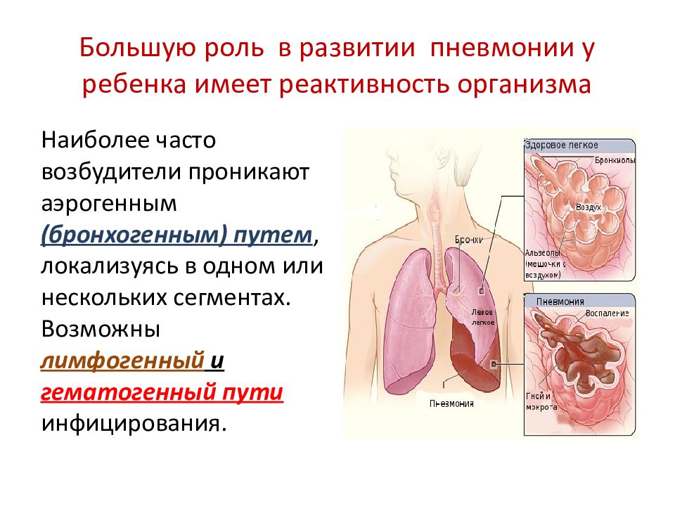 Развивающаяся пневмония. Воспаление лёгких кратко. Причины развития воспалительного процесса в легких у детей. Пневмония у детей кратко. Патогенез пневмонии у детей.