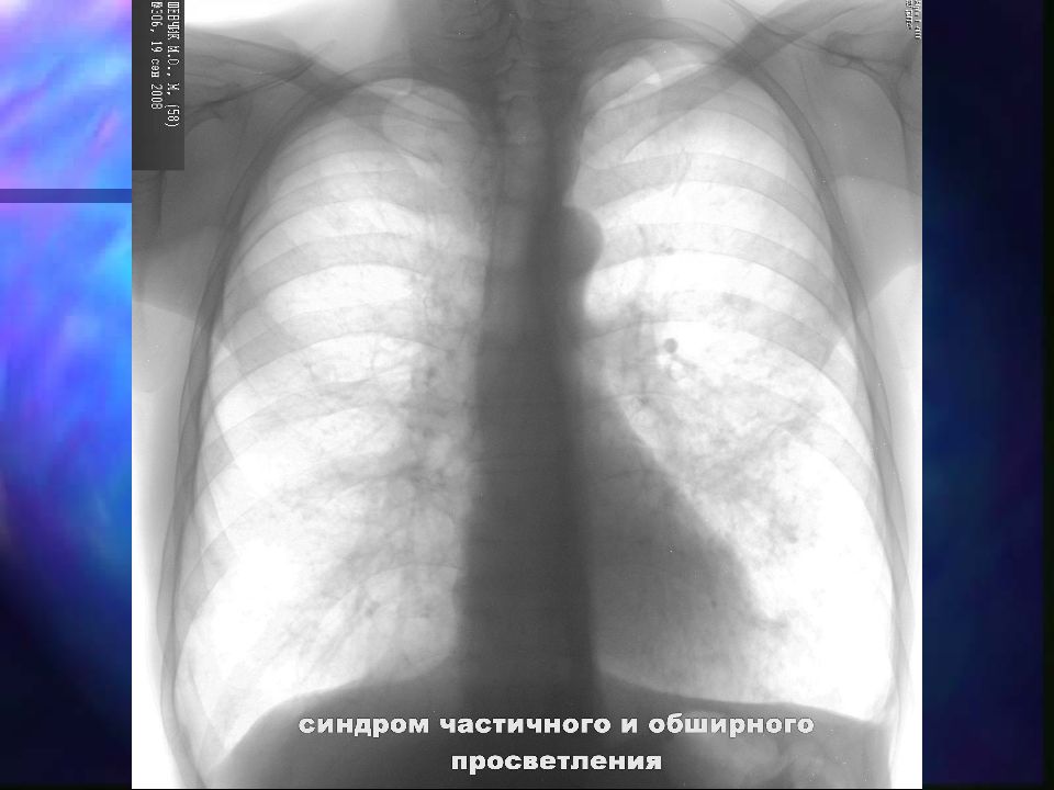 Синдромы легких. Синдром обширного просветления. Синдром затемнения легочной ткани на рентгене. Синдром обширного просветления легочного поля. Просветление на рентгенограмме.