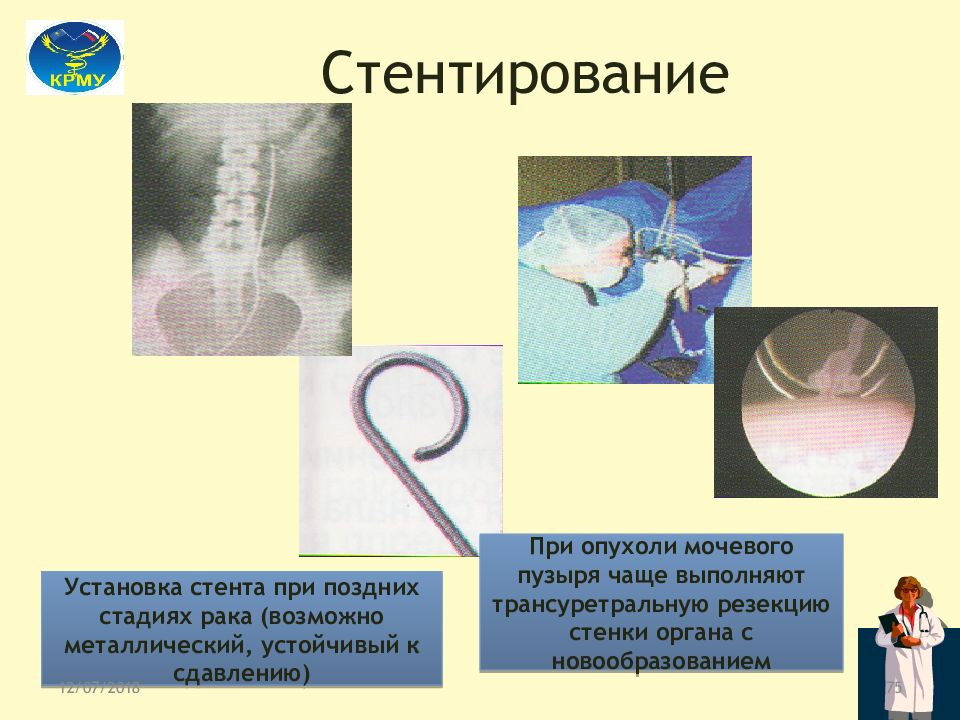 Стент при беременности. Катетеризация и стентирование мочеточника.