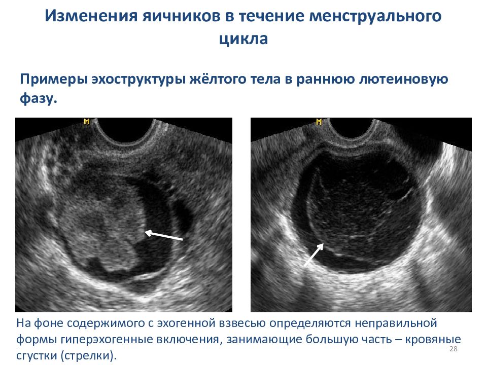 Киста желтого тела картинки