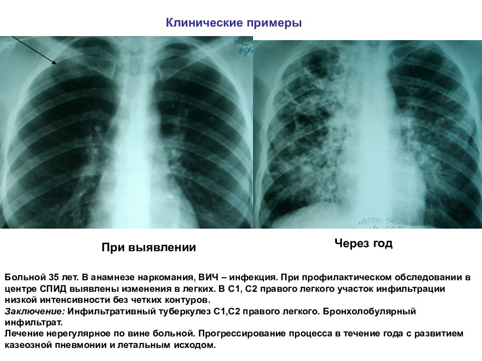 Очаговый и инфильтративный туберкулез презентация