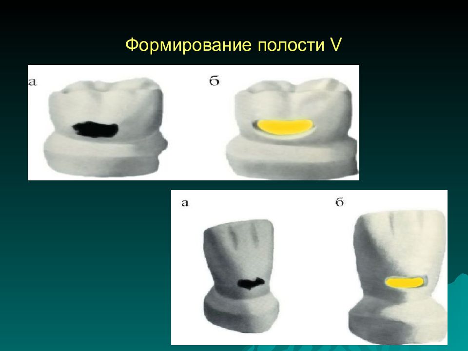 Препарирование кариозных полостей по блэку презентация