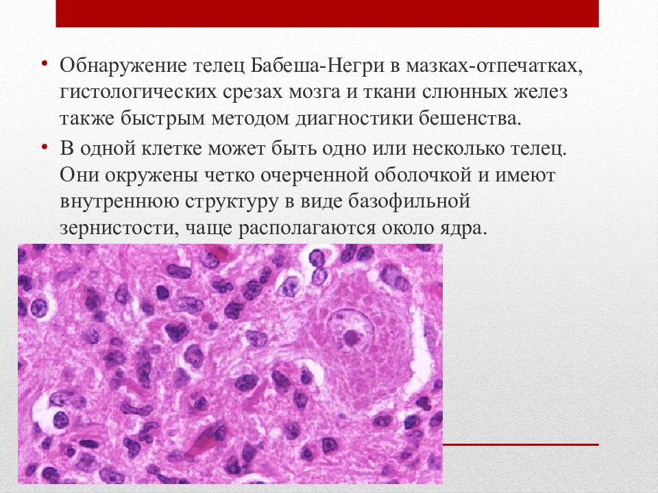 Тельца негри. Тельца Бабеша негри мазок. Включения Бабеша негри. Тельца Бабеша негри микробиология. Обнаружение Телец Бабеша-негри.