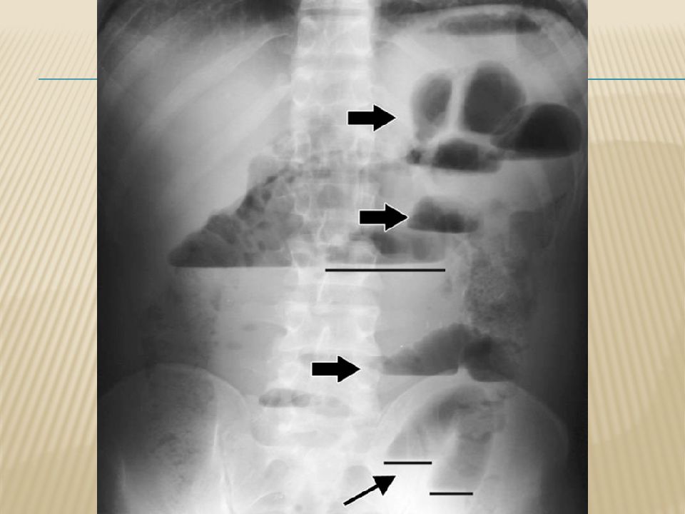 Кишечная непроходимость рентген. Кишечная непроходимость чаши Клойбера. Чаши Клойбера при кишечной непроходимости. Тонкокишечная непроходимость рентген.