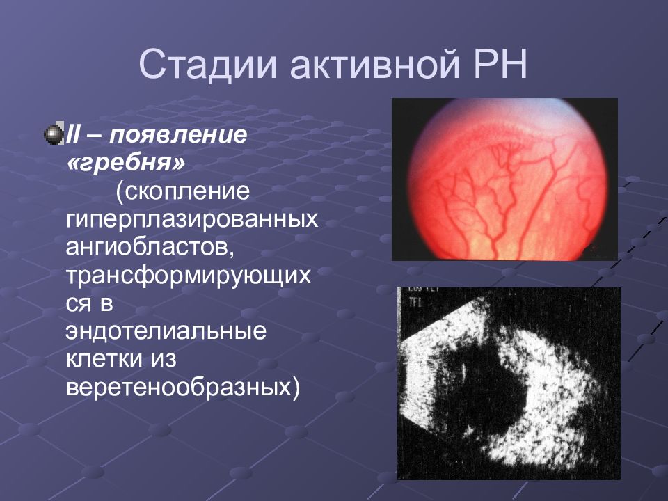 Ретинопатия недоношенных презентация