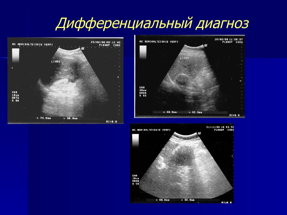 Очаговые поражения печени.