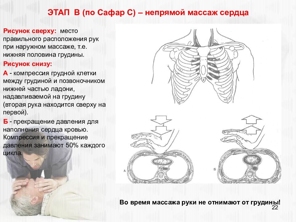 Непрямой сердца. Непрямой массаж сердца этапы. Непрямой массаж сердца по этапам. Этапы по Сафару этап а и в. Непрямой массаж сердца руки располагаются.