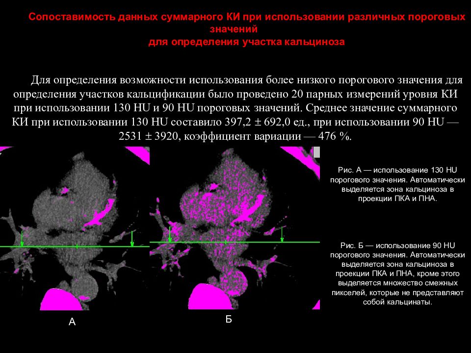 Кт скрининг коронарного кальция