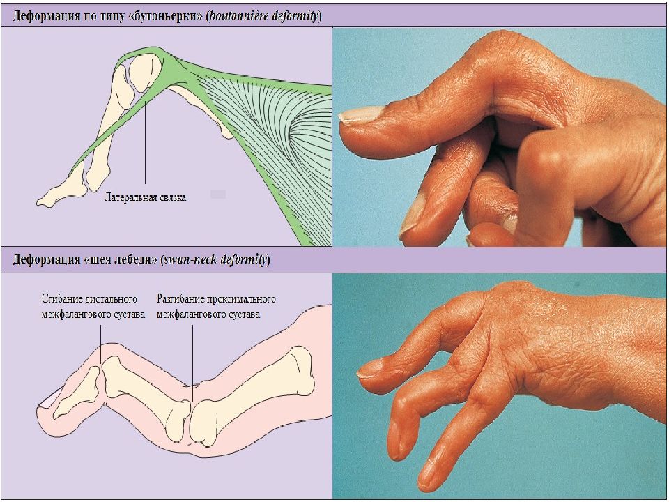 Деформация пальцев по типу бутоньерки. Деформация пальцев Лебединая шея. Поражение пальцев кистей по типу «бутоньерки».