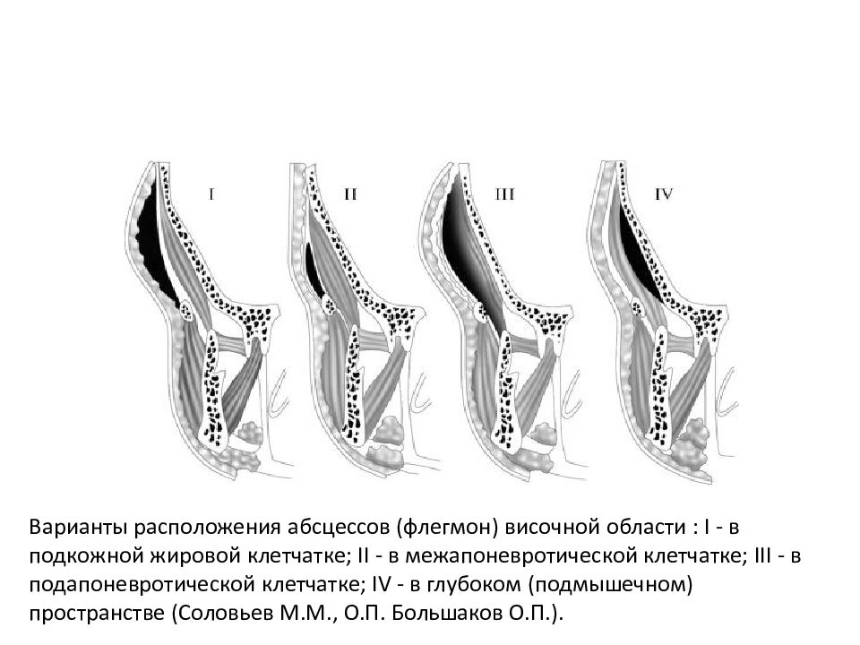 Схема вскрытия разлитой флегмоны височной области