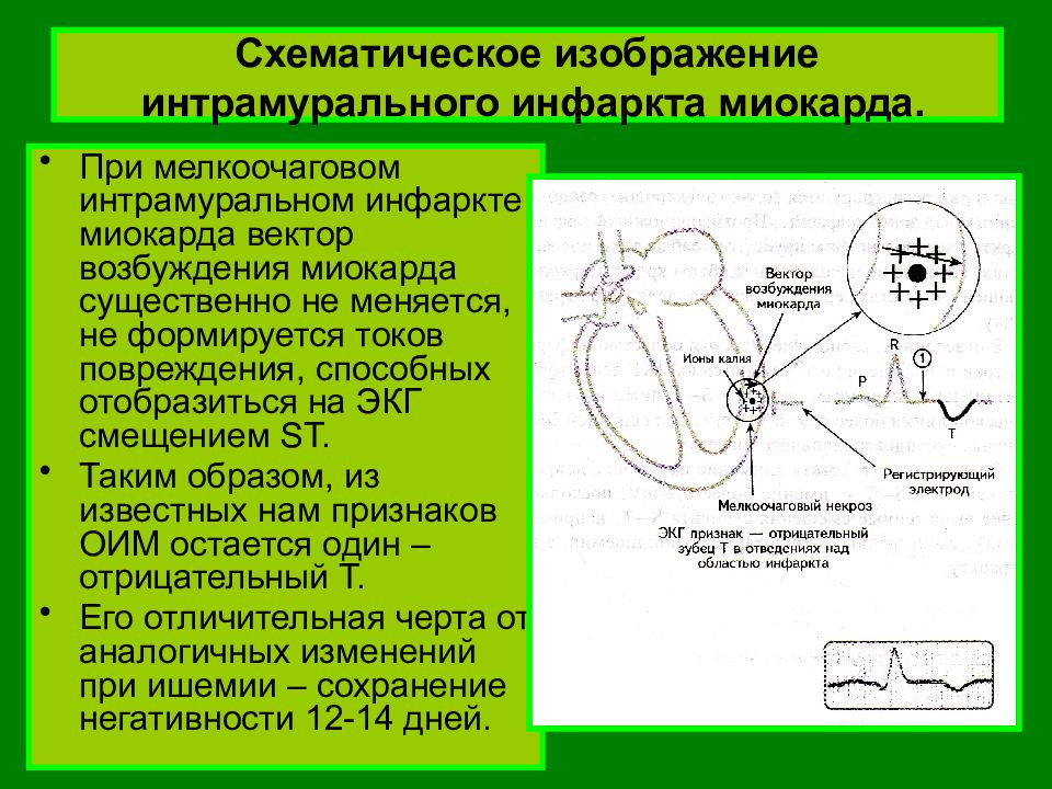 Экг зоны