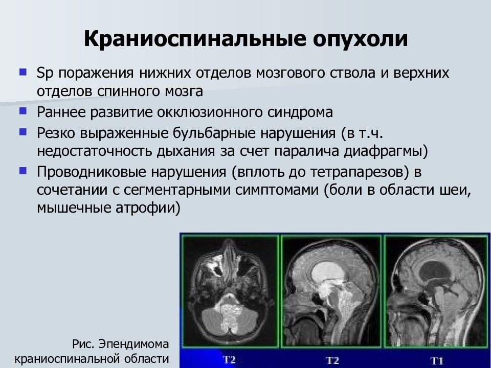 Опухоль мозга презентация