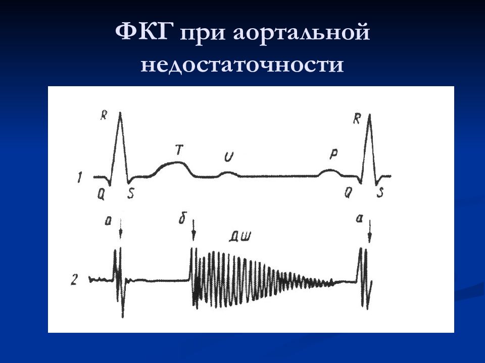 Аускультативная картина аортальной недостаточности тест