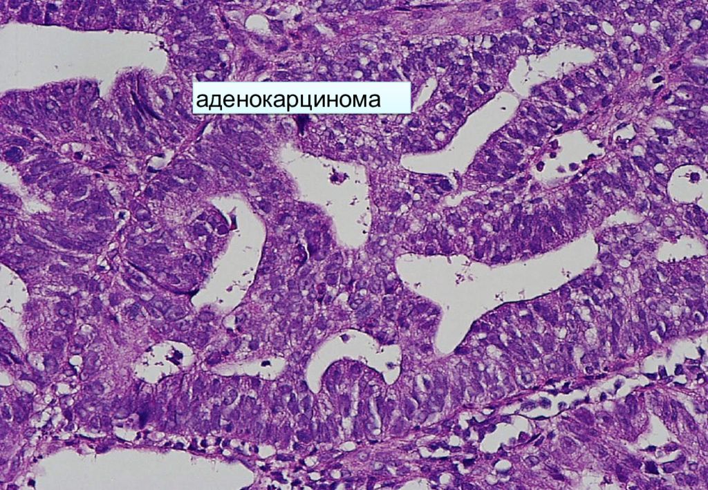 Аденокарцинома что это. Аденокарцинома толстой кишки гистология. Аденокарцинома толстой кишки микропрепарат. Аденокарцинома прямой кишки микропрепарат. Аденокарцинома в ворсинчатой аденоме толстой кишки микропрепарат.