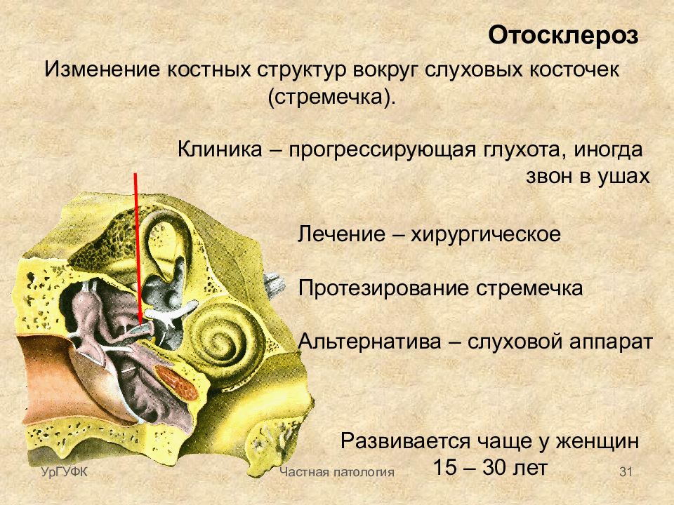 Отосклероз уха операция