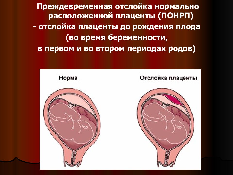 Ранняя плацента. Преждевременная отслойка нормально расположенной плаценты. Отслойка нормальной расположенной плаценты. Профилактика преждевременной отслойки плаценты. Отслойка нормально расположенной плаценты симптомы.