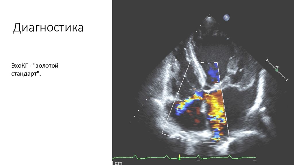 Аневризма межпредсердной перегородки. Дефект межпредсердной перегородки на ЭХОКГ. Аневризма межпредсердной перегородки на ЭХОКГ. Аневризма межпредсердной перегородки Эхо кг.