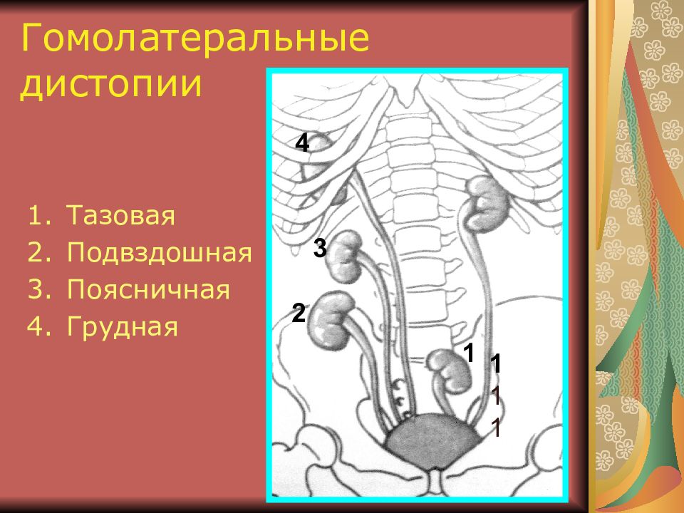 Дистопия почки. Гетеролатеральная дистопия почки. Подвздошная дистопия почки. Аномалии расположения почек дистопия. Гомолатеральная дистопия почки.