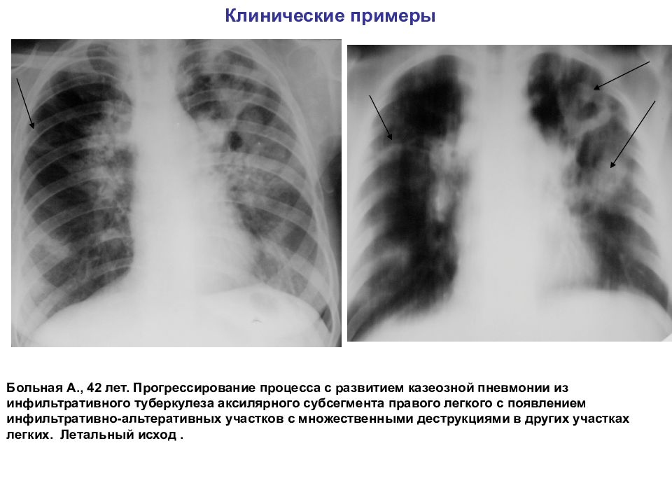 Возможные варианты развития клинической картины при туберкулезе легких