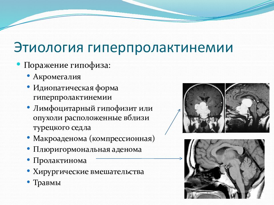 Опухоль гипофиза. Гиперпролактинемия патофизиология. Этиоллогияпролактином гипофиза. Гиперпролактинемия этиология. Гиперпролактинемия гипофиз.