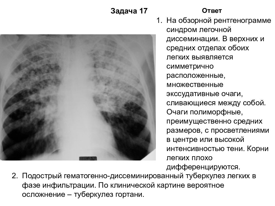 Туберкулез легких карта вызова