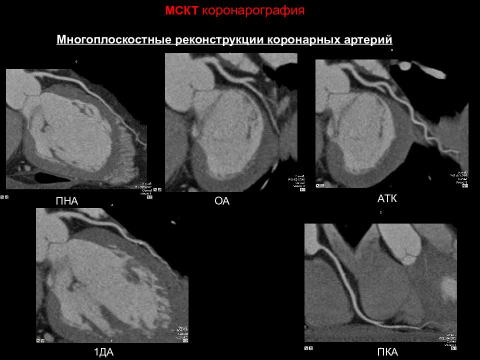 Кт скрининг коронарного кальция