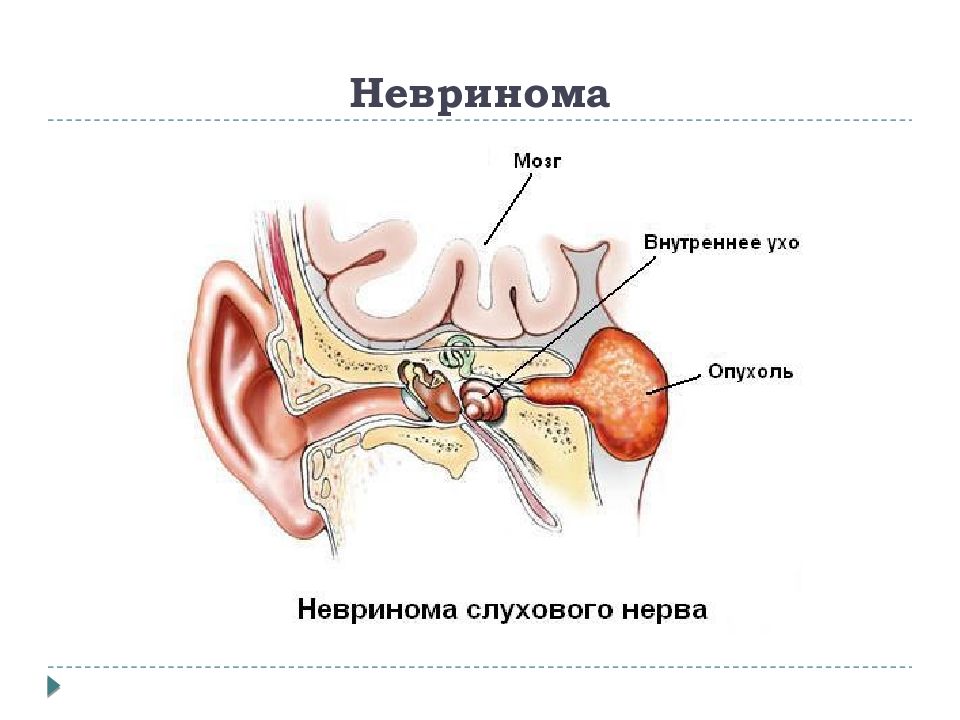 Неврит слухового нерва презентация