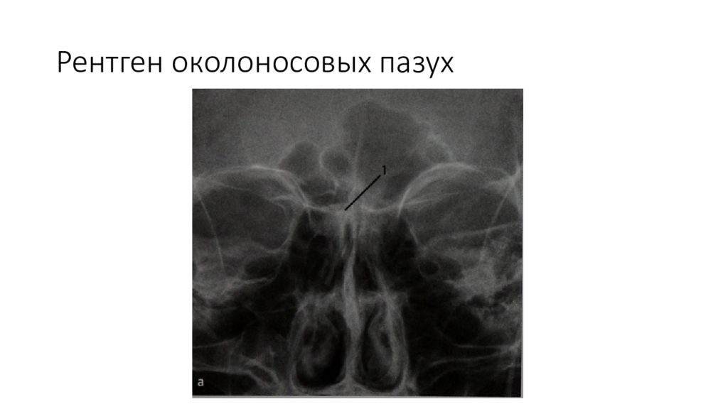 Рентген околоносовых пазух
