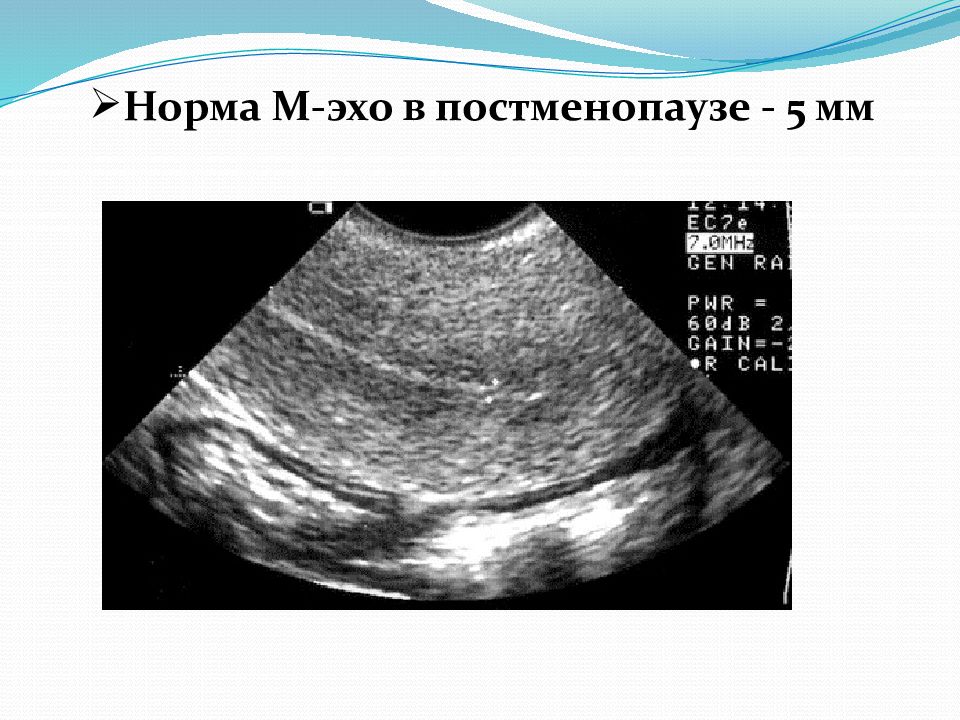 Эндометрий 6 5. Эндометрия матки УЗИ гиперплазия эндометрия. М-Эхо 14 мм линейный. М Эхо в постменопаузе. Эндометрия в постменопаузе по УЗИ.
