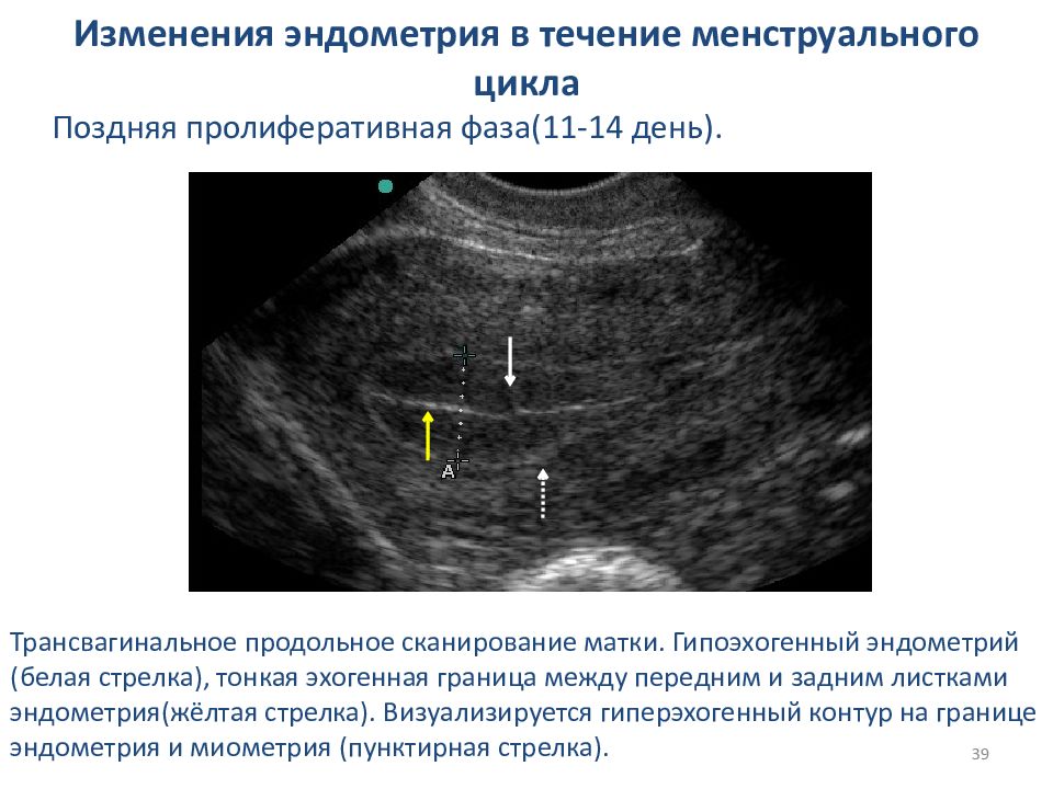 Низкий эндометрий. Толщина эндометрия в 1 фазу менструального цикла. Толщина эндометрия по дням цикла по УЗИ. Норма эндометрия по УЗИ. Эндометрий на УЗИ норма.