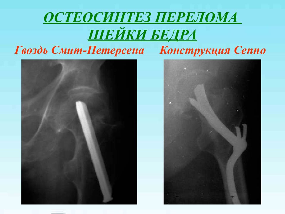 Перелом шейки бедра презентация