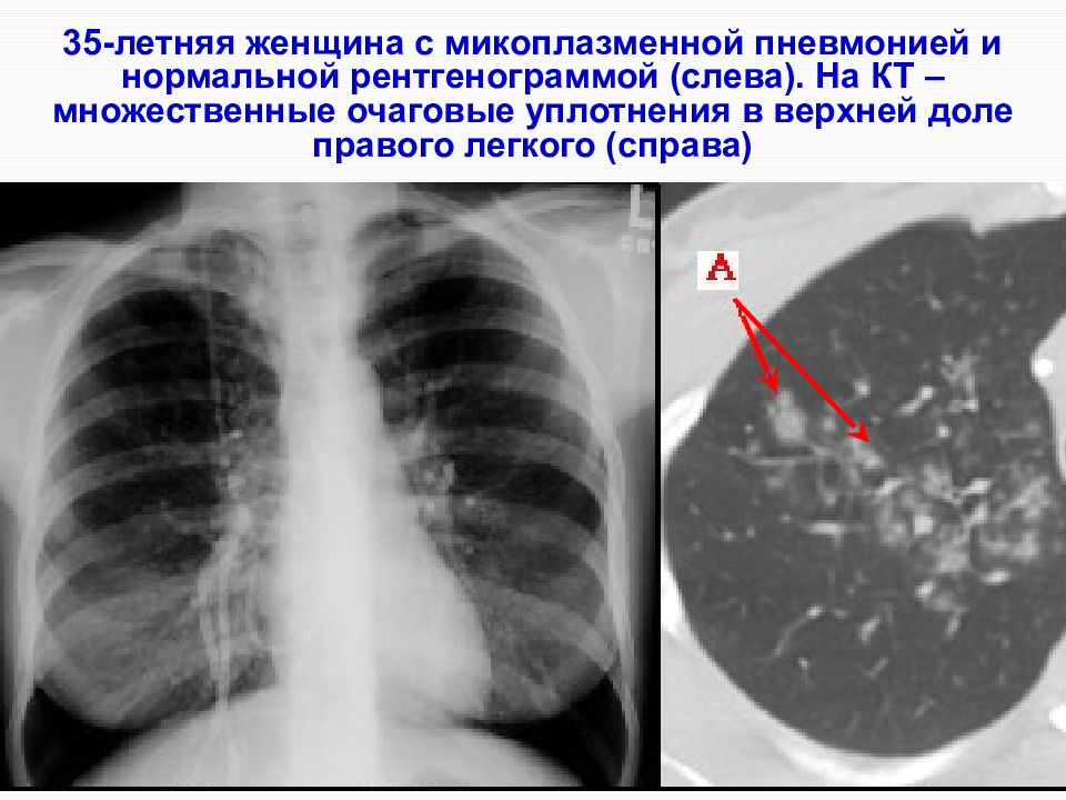 Легочный рисунок при пневмонии