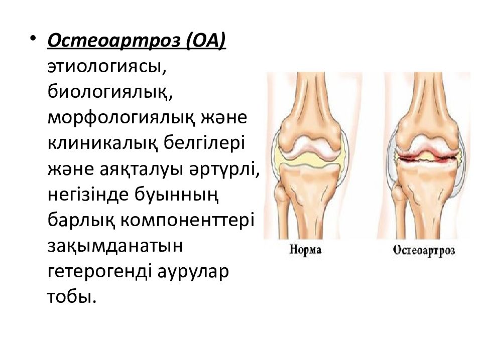Остеоартроз что это такое как лечить. Деформирующий остеоартроз симметричность. Проявление остеоартроза.