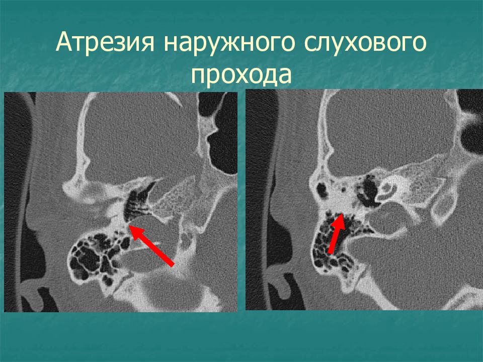 Мрт височных костей режимы. Сосцевидный отросток височной кости кт. Сосцевидный отросток на кт. Анатомия височной кости кт. Атрезия слухового прохода на кт.