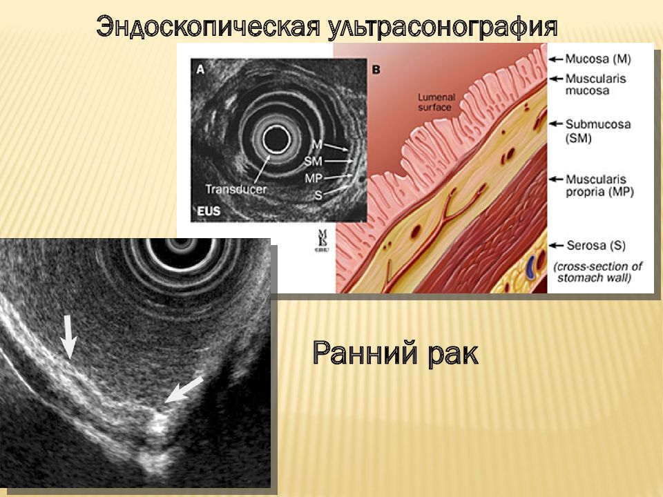 Узи эндоскопия. Эндосонографию желудка. Сонография поджелудочной железы. Эндоскопическая ультрасонография пищевода.