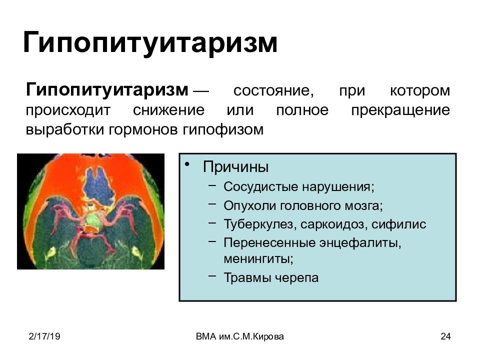 Гипопитуитаризм что это. Гипопитуитаризм. Диагноз гипопитуитаризм. Гипопитуитаризм осложнения. Врожденный гипопитуитаризм.