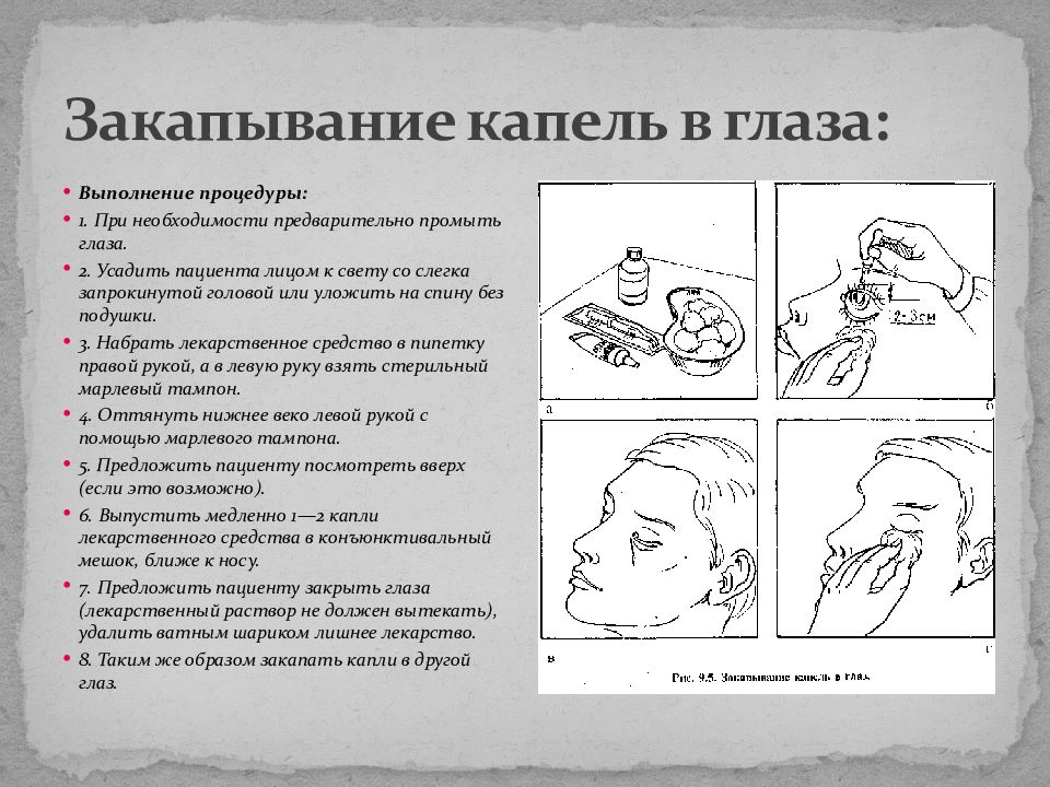 Закапывание глаз. Закапывание капель в нос алгоритм. Техника закапывания капель в нос. Положение головы при закапывании капель в нос. Устройство для закапывания в глаза.