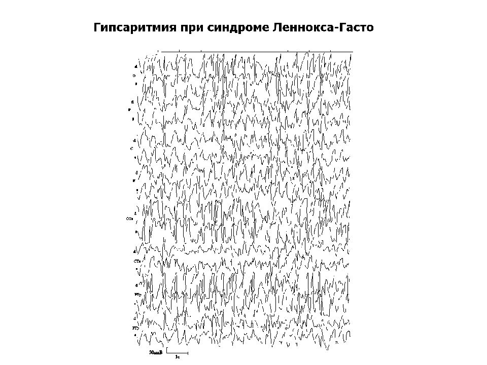 Синдром леннокса гаста. Синдром Леннокса Гасто ЭЭГ. ЭЭГ при синдроме Леннокса Гасто. Заключение ЭЭГ при синдроме Леннокса Гасто. Леннокса Гасто эпилепсия.