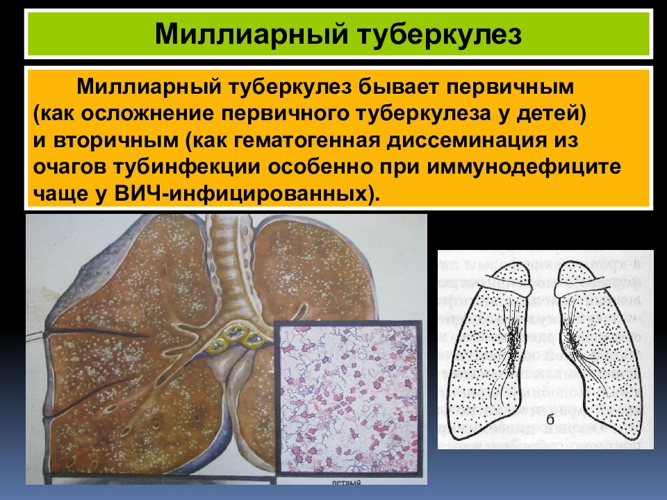 Первичный туберкулез. Первичный очаг туберкулеза. Осложнения первичного туберкулеза. Осложнения диссеминированного туберкулеза. Первичный туберкулез презентация.