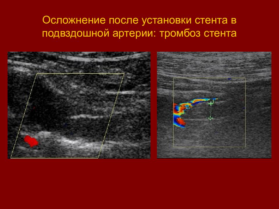 осложнения после стентирования. операция стентирование сосудов сердца. атеросклеротическое поражение коронарных артерий. осложнения после стентирования. операция стентирование сосудов сердца.