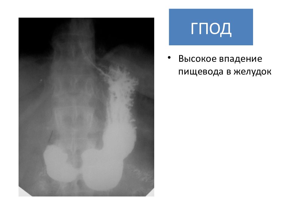 Гпод это. Грыжа диафрагмы пищевода рентген.