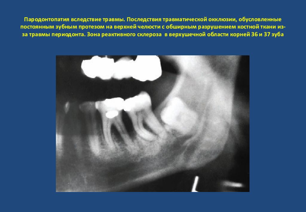 Рентгенологическая картина костной ткани челюстей при пародонтите тяжелой степени
