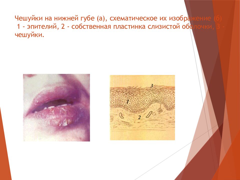 Чешуйки на нижней губе (а), схематическое их изображение (б) 1 - эпителий, 2 - собственная пластинка слизистой оболочки, 3 - чешуйки.