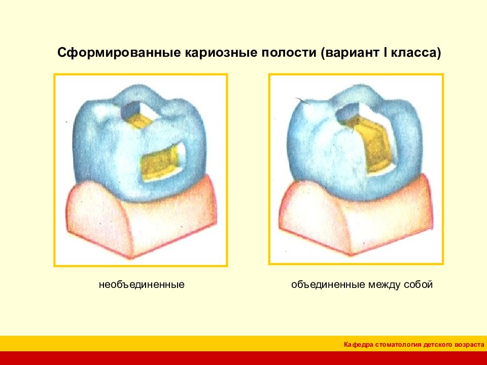 Препарирование кариозных полостей по блэку презентация