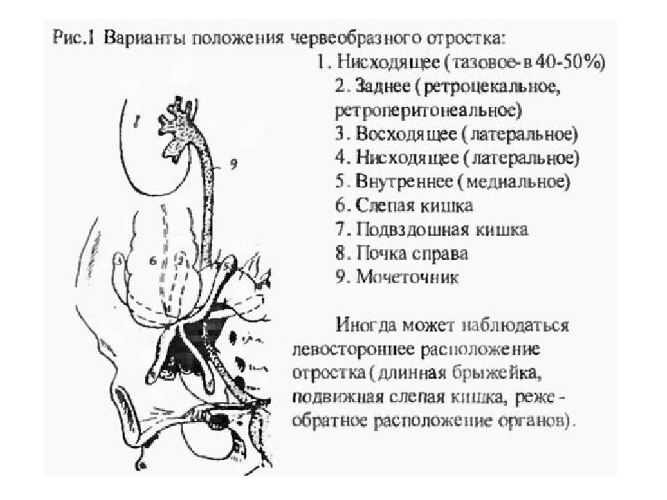 Аппендицит. Диагностика. Техника оперативного лечения - презентация онлайн