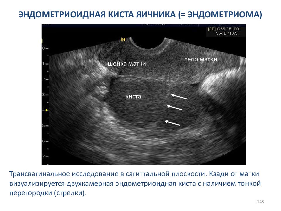 Опасные размеры кисты