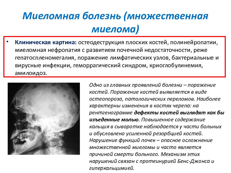 Миеломная болезнь симптомы