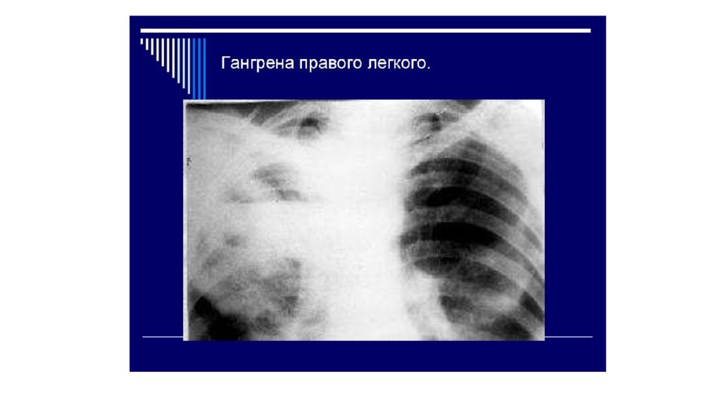 Презентация на тему абсцесс легких