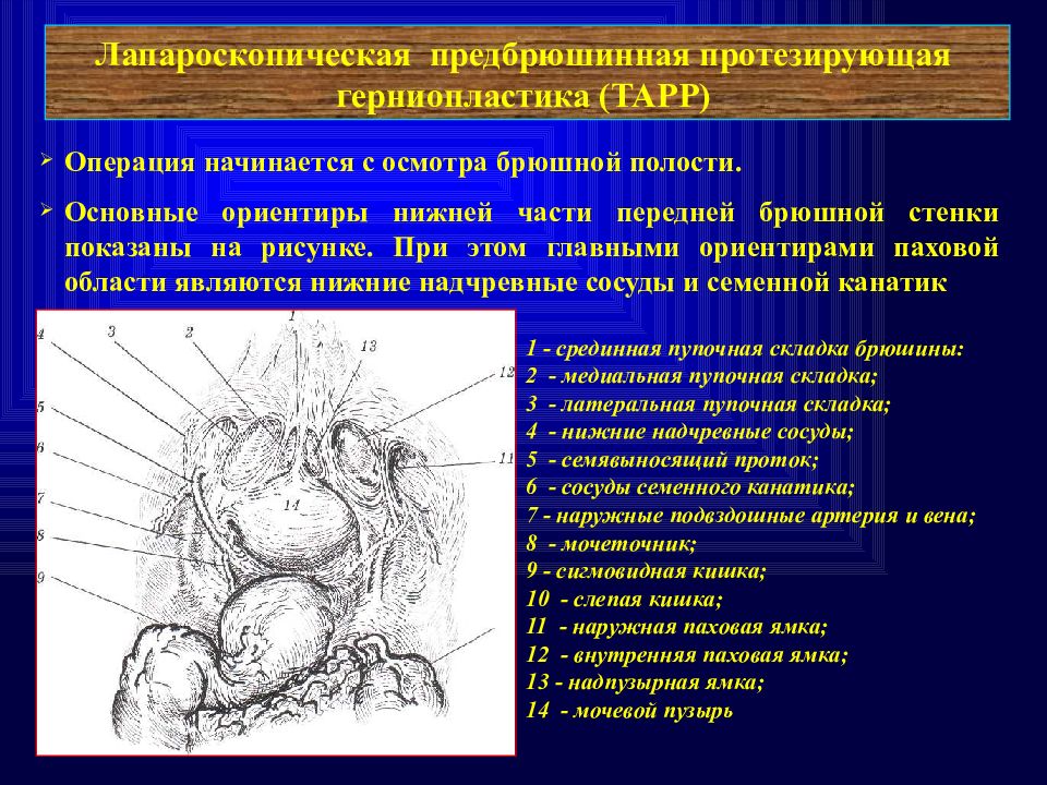 Паховая грыжа мкб. Надпузырная паховая ямка. Надпузырная внутренняя грыжа. Надпузырная паховая грыжа.