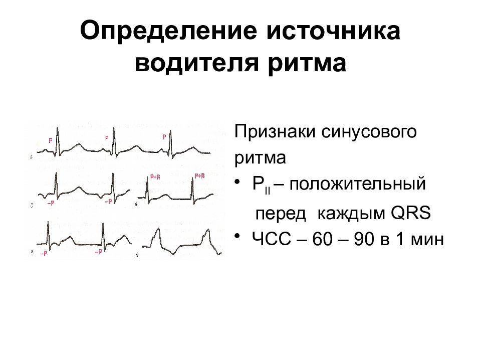 Синусовый ритм qrs. Критерии синусового ритма на ЭКГ. Источник ритма: синусовый. Назовите признаки синусового ритма.